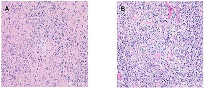 Kikuchi-Fujimoto Disease With Encephalopathy in Children: Case Reports and Literature Review